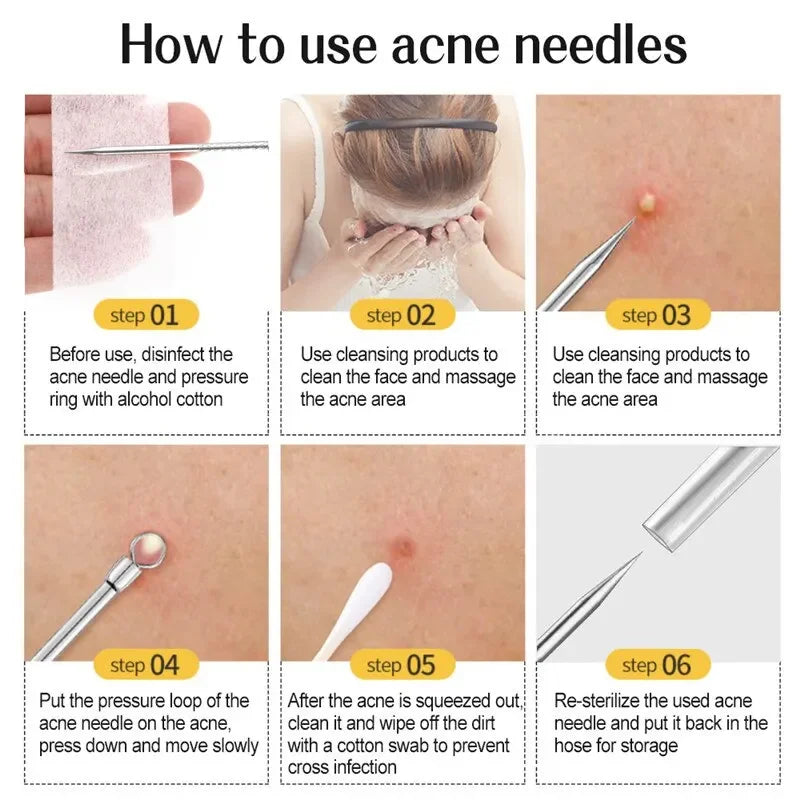 ✨ Professional 11-in-1 Blackhead Remover Kit – Acne Extractor Needles & Pore Cleansing Tools ✨