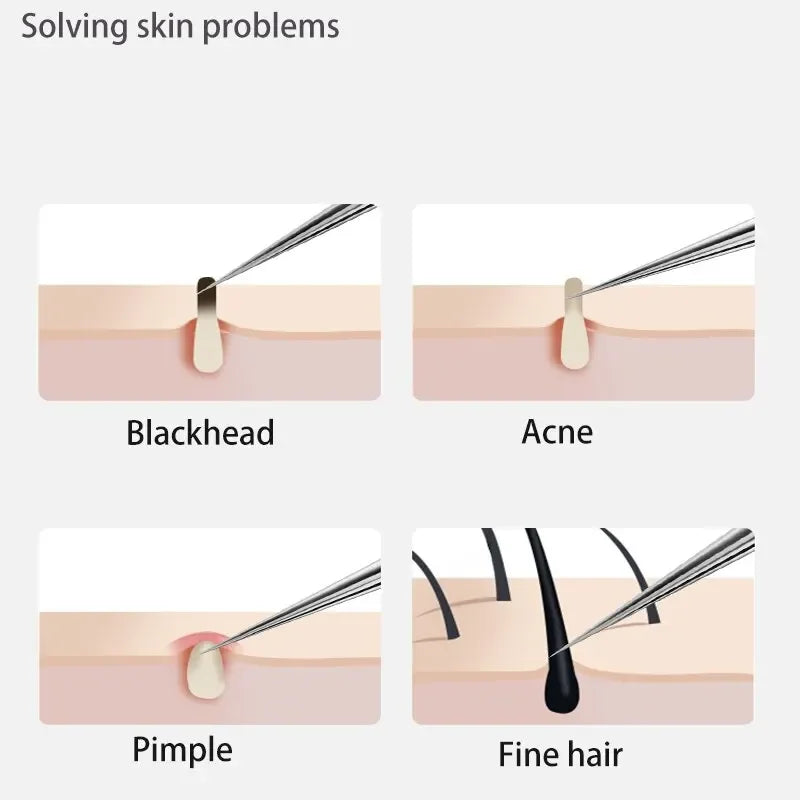 ✨ Professional 11-in-1 Blackhead Remover Kit – Acne Extractor Needles & Pore Cleansing Tools ✨
